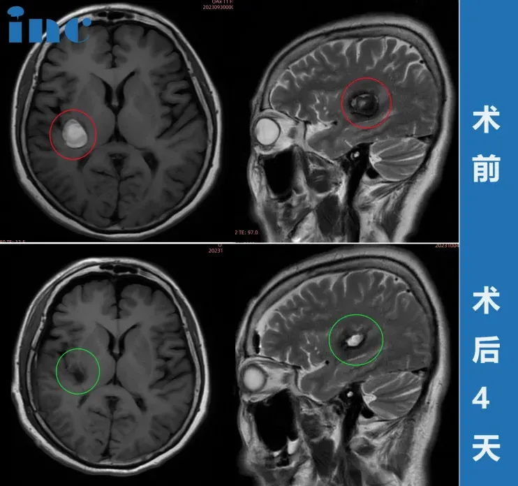 <a href='/naoxueguanliu/' target='_blank'><u>腦海綿狀血管瘤</u></a>開(kāi)顱手術(shù)