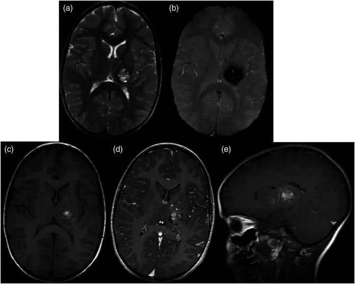圖2：患者5歲時一次就診時的MRI。