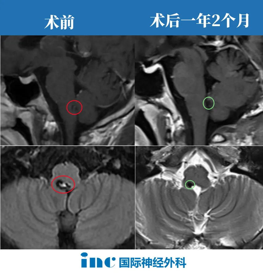 腦干海綿狀血管瘤成功案例
