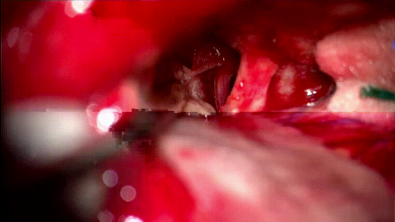 取出腫瘤瞬間