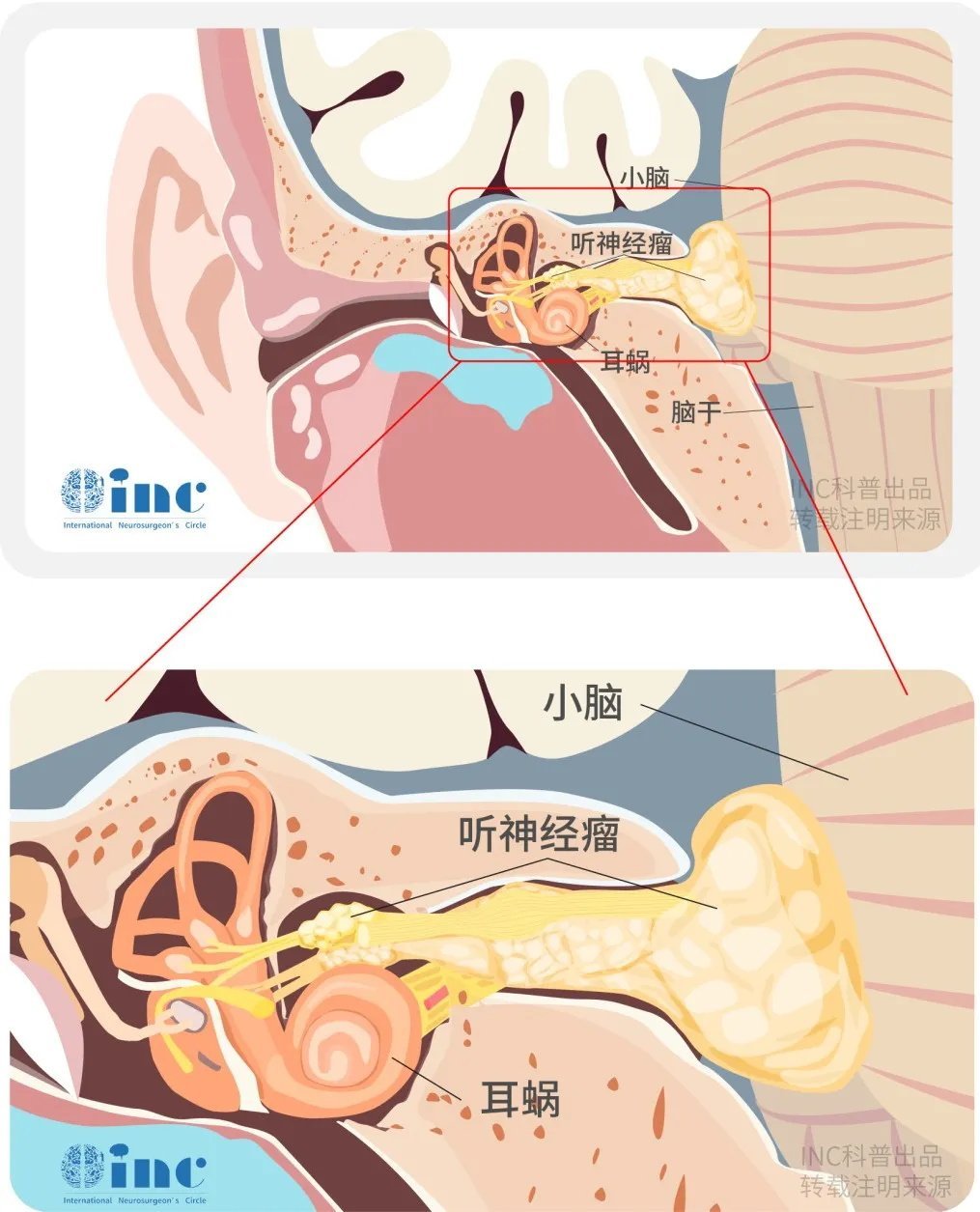 聽神經(jīng)瘤為何會(huì)導(dǎo)致面癱？