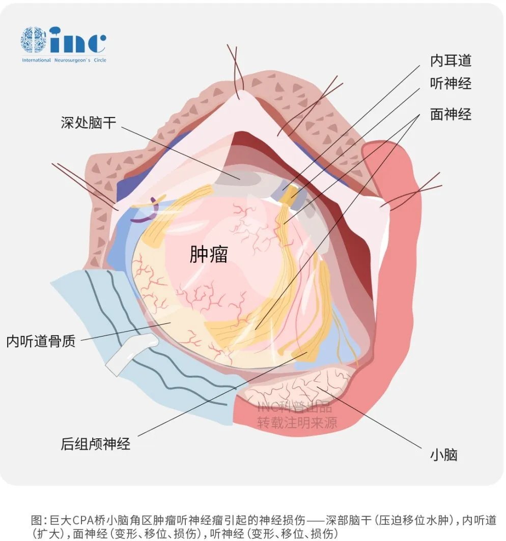 聽神經(jīng)瘤位于CPA區(qū)——小腦巖骨面包繞橋腦側(cè)方形成該區(qū)域