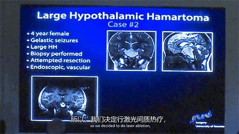 LITT技術(shù)消融元兇下丘腦錯構(gòu)瘤