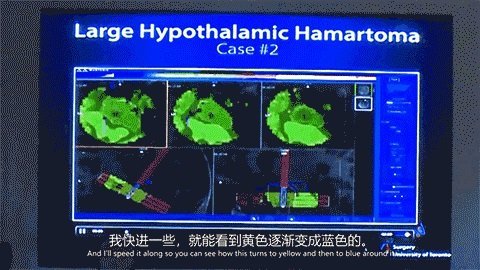 LITT技術(shù)消融元兇下丘腦錯構(gòu)瘤