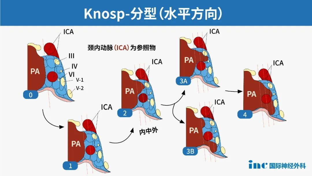 冠狀位上通過頸內(nèi)動脈內(nèi)側(cè)緣、中心、外側(cè)緣作三條連線，通過評估垂體腺瘤與這三條線的關(guān)系做出分級分類