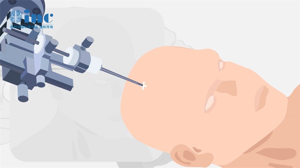 垂體瘤術后腦脊液漏概率高嗎?有生命危險嗎?