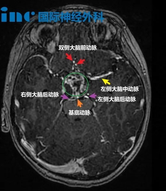 7歲男孩-鞍上區(qū)囊實(shí)性占位疑似顱咽管瘤。一次摔倒，竟然“摔”出腦腫瘤
