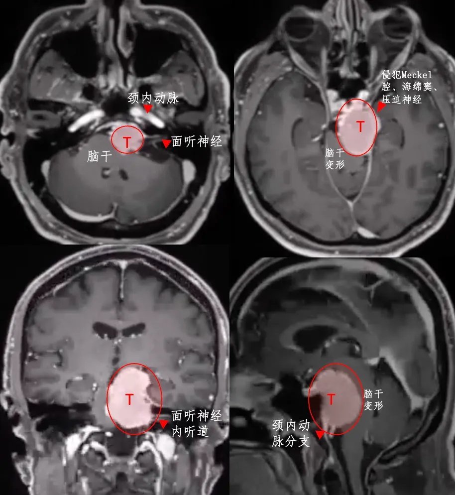 腫瘤位置深、體積大，已經(jīng)壓迫腦干