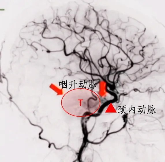 腫瘤被血管包繞，主要是咽升動(dòng)脈和頸內(nèi)動(dòng)脈硬腦膜分支，術(shù)中易損傷出血