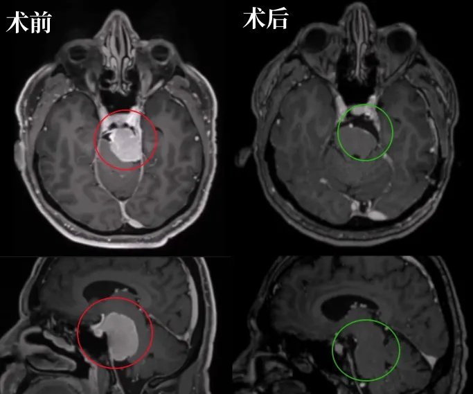 術(shù)后MRI顯示腫瘤幾乎完全切除，腦干受壓解除。