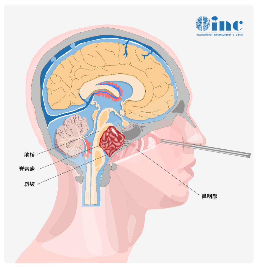 神經(jīng)內(nèi)鏡近年來(lái)逐漸成為顱底疾病，如鞍區(qū)腫瘤、如鞍區(qū)腫瘤、脊索瘤、環(huán)枕畸形、顱底凹陷等重要手術(shù)方式之一。