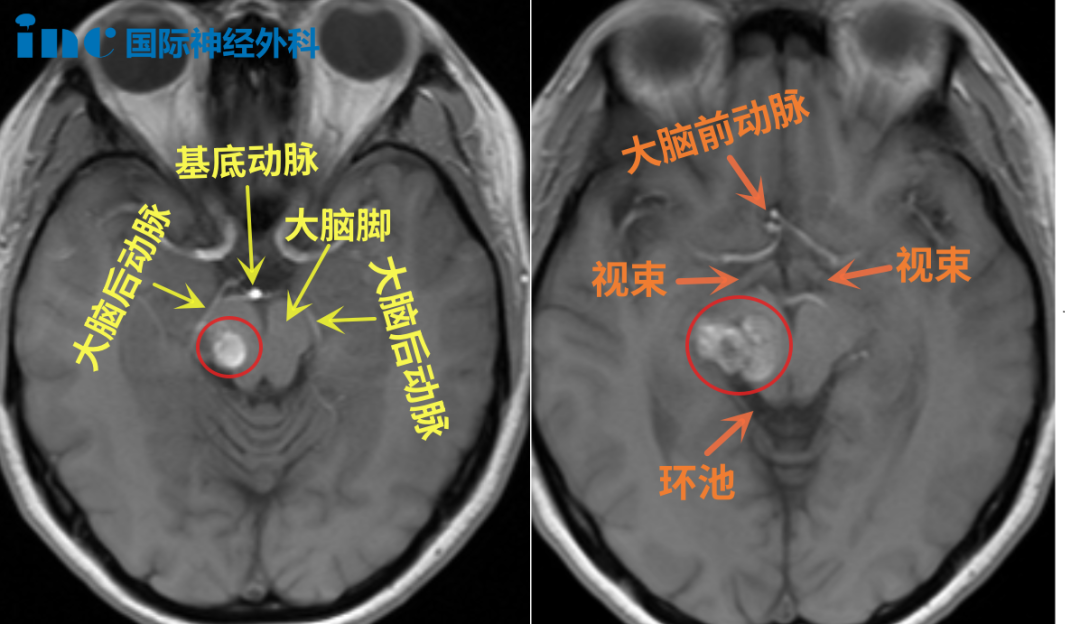 病灶位于丘腦等重要功能區(qū)，周邊毗鄰大腦后動脈、基底動脈、大腦前動脈、視束等重要結(jié)構(gòu)