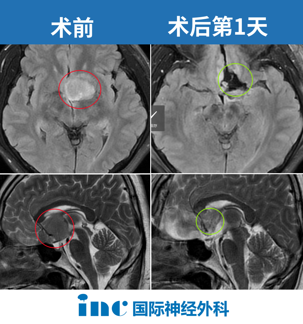 術(shù)后腫瘤切除達(dá)到預(yù)期，并且神經(jīng)功能保護(hù)得很好，無任何新發(fā)神經(jīng)功能損傷