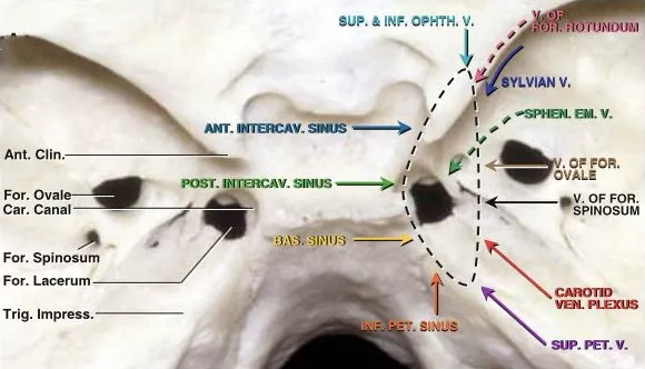 在這種情況下，腫瘤可以橫向延伸到海綿竇或向后延伸到后床突和巖斜區(qū)。