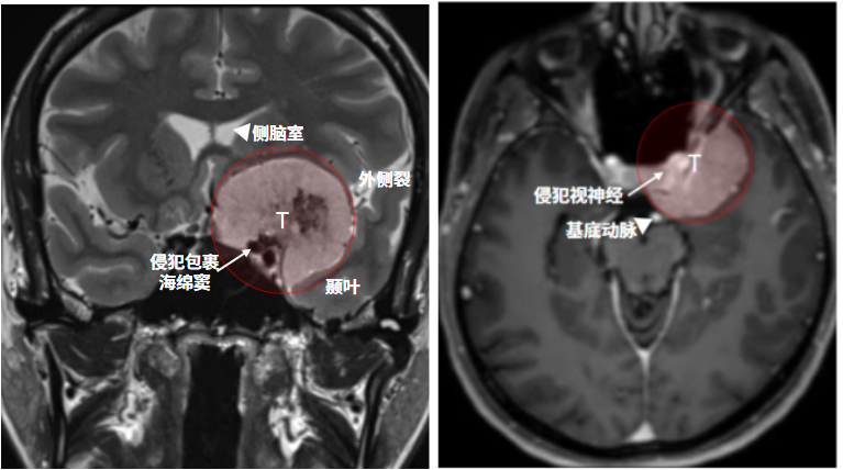 一個(gè)較大且出現(xiàn)部分鈣化的床突腫瘤，包裹頸內(nèi)動(dòng)脈及其分支，壓迫視神經(jīng)。