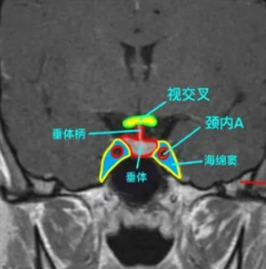 患者通常表現為鄰近結構的局部腫塊效應癥狀(是視交叉)