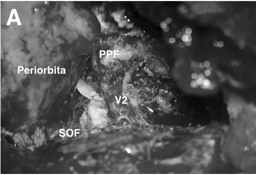 SOF、PPF和V2暴露，注意保護神經(jīng)血管，識別和定位腫瘤。