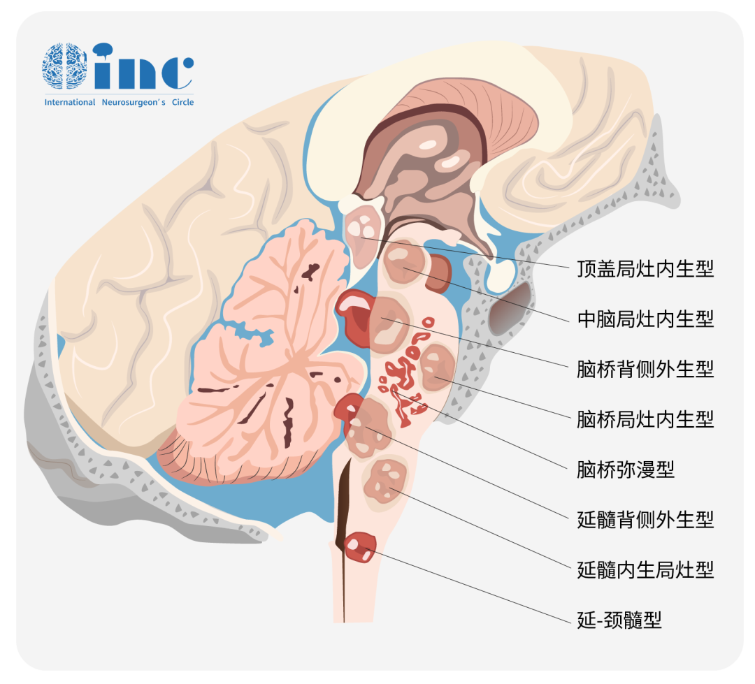 發(fā)生于胼胝體、三腦室、丘腦、腦干等中線結(jié)構(gòu)的高級別腦膠質(zhì)瘤——彌漫中線膠質(zhì)瘤