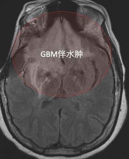 ▼高信號(hào)，顱內(nèi)多發(fā)病灶，雙側(cè)額葉廣泛病變,越過(guò)中線，累及胼胝體。