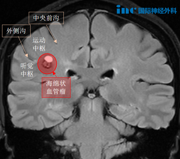 經(jīng)歷過一次出血、病灶小，為何她會(huì)果斷選擇手術(shù)？