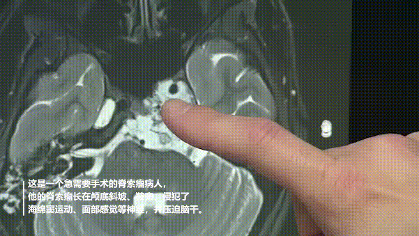 福教授在術(shù)前分析患者影像資料，指出腫瘤所在位置及周邊重要腦組織及結(jié)構(gòu)。