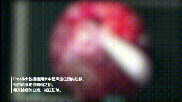 術(shù)中超聲定位頸內(nèi)動(dòng)脈，頸內(nèi)動(dòng)脈定位明確之后，便開(kāi)始瘤體分離、減壓切除。而后，他開(kāi)始切除基底動(dòng)脈及腦干邊的腫瘤，并注意小心分離血管，注意保護(hù)腦干等關(guān)鍵結(jié)構(gòu)