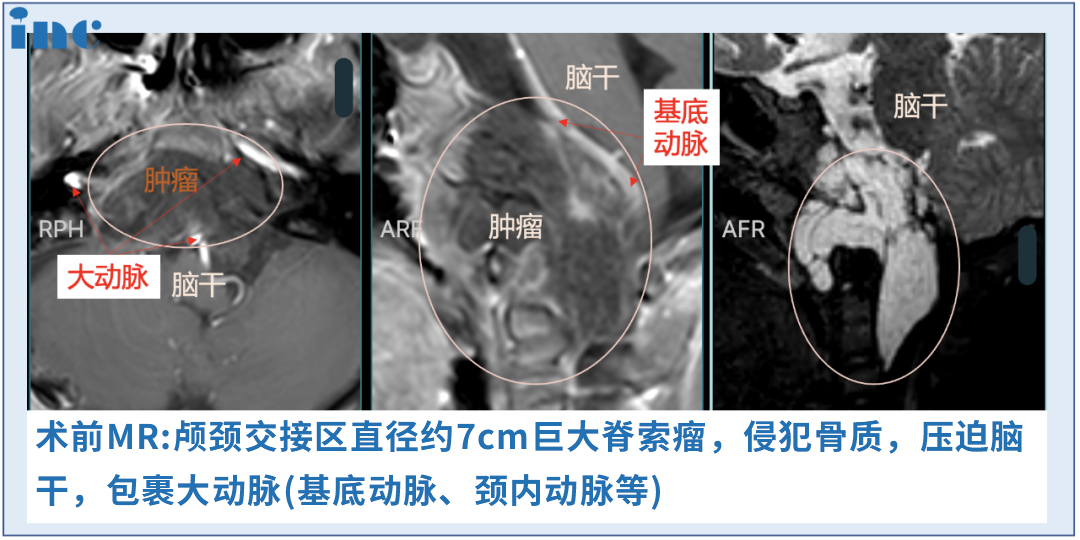 6歲男孩較大脊索瘤，單鼻孔8mm切口、不開(kāi)顱成功手術(shù)
