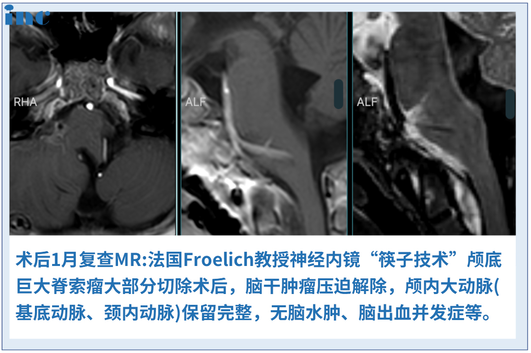 6歲男孩較大脊索瘤，單鼻孔8mm切口、不開(kāi)顱成功手術(shù)
