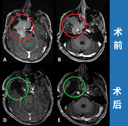 手術(shù)順利完成，根據(jù)術(shù)前術(shù)后影像對比，患者腫瘤得到完全切除。