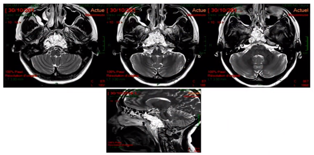 這是術(shù)后的MRI，高信號的是脂肪組織。