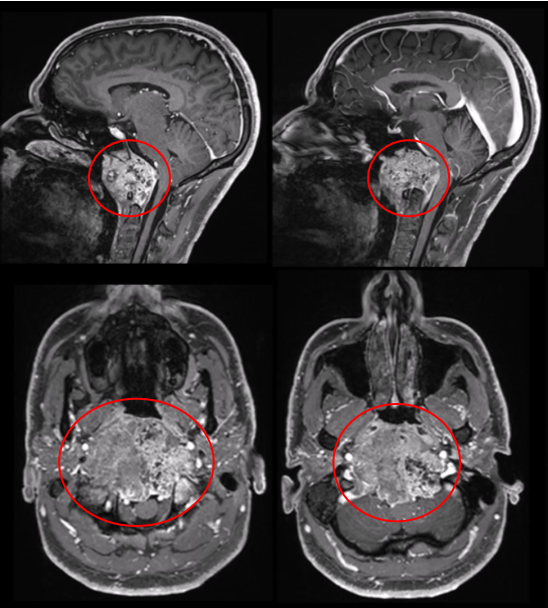 術(shù)前MRI，較大顱頸交界區(qū)脊索瘤，腫瘤較大直徑達10cm、瘤體積96.5cm3，腫瘤并向雙后外側(cè)延伸浸潤性生長，