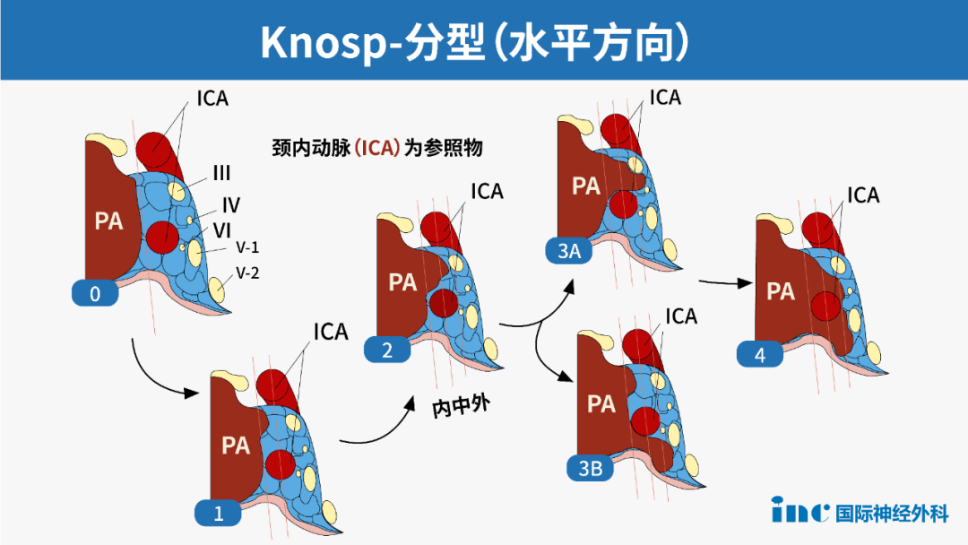 表1.垂體腺瘤改良Knosp分級