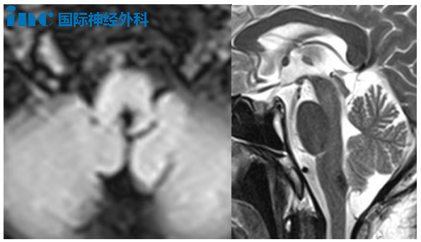 腦干-腦橋海綿狀血管瘤  53歲男性 蘇先生