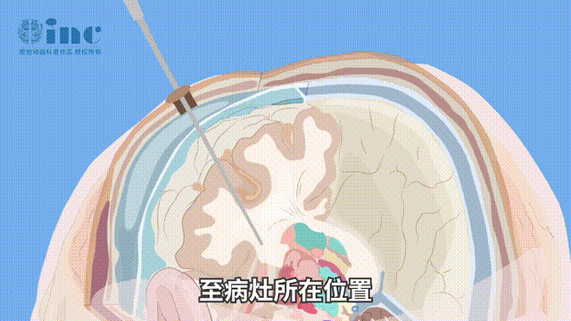 LITT在顱內(nèi)疾病的治療中越來越受歡迎，包括兒童神經(jīng)腫瘤和癲癇。
