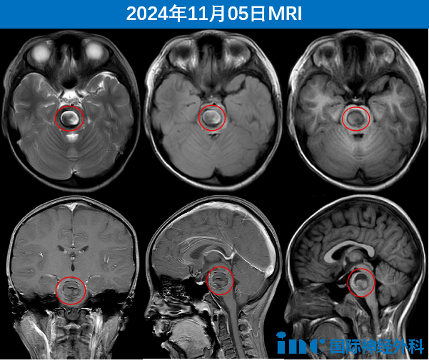 這“神”來之術(shù)  開顱術(shù)后當天竟未進ICU——兒童疑難<a href='/naoliu/' target='_blank'><u>腦瘤</u></a>示范手術(shù)順利進行！