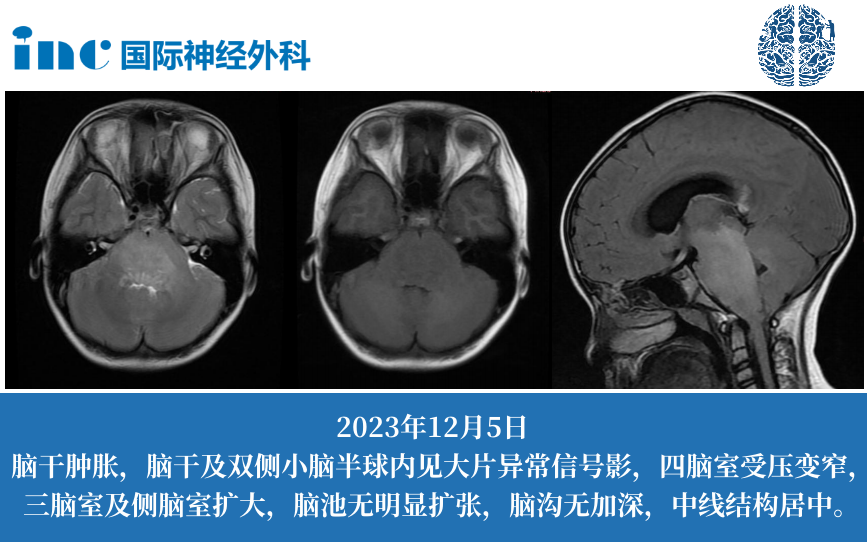 核磁共振掃描顯示，彌漫性腦干病變累及延髓、腦橋和中腦下部。第四腦室受到壓迫，導(dǎo)致幕上腦積水。
