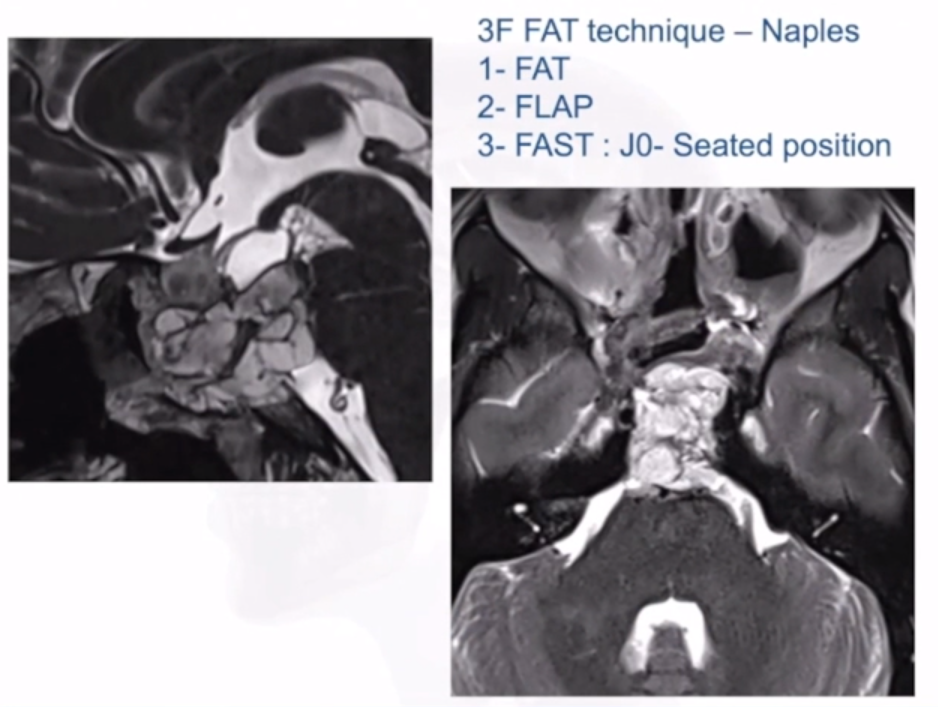 3F技術(Fat，F(xiàn)lap，F(xiàn)lash)：有效降低腦積液發(fā)生率