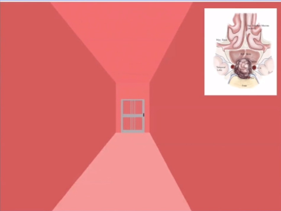這是我經(jīng)常使用的一個概念性圖示，其中的“門”類似于蝶竇的前壁，是我們希望打開的目標位置，以便進入蝶竇腔內(nèi)。