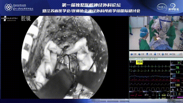 保證充分的骨瓣骨窗暴露是入路的關(guān)鍵，根據(jù)術(shù)中病灶的情況隨時(shí)彌補(bǔ)骨窗暴露的不足，以達(dá)到更好的術(shù)野暴露。