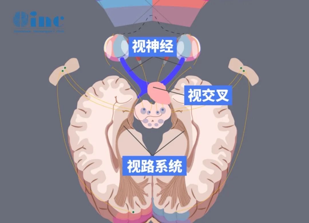 局限在視神經(jīng)眶內(nèi)和部分神經(jīng)管內(nèi)的視神經(jīng)膠質(zhì)瘤幾乎可以通過手術(shù)被治愈。
