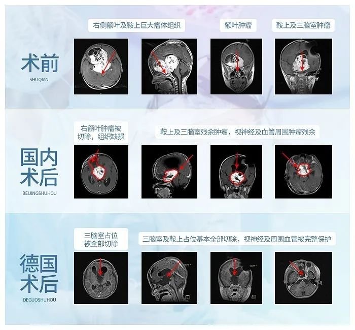 INC國際巴教授近全切腫瘤