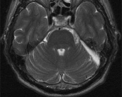 術(shù)后 MRI 圖像顯示腫瘤已完全切除。