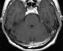 術(shù)后 MRI 圖像顯示腫瘤已完全切除。