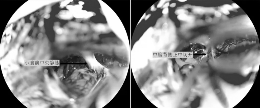 首先幕下小腦上入路，切除腫瘤上部及第三腦室上部腫瘤
