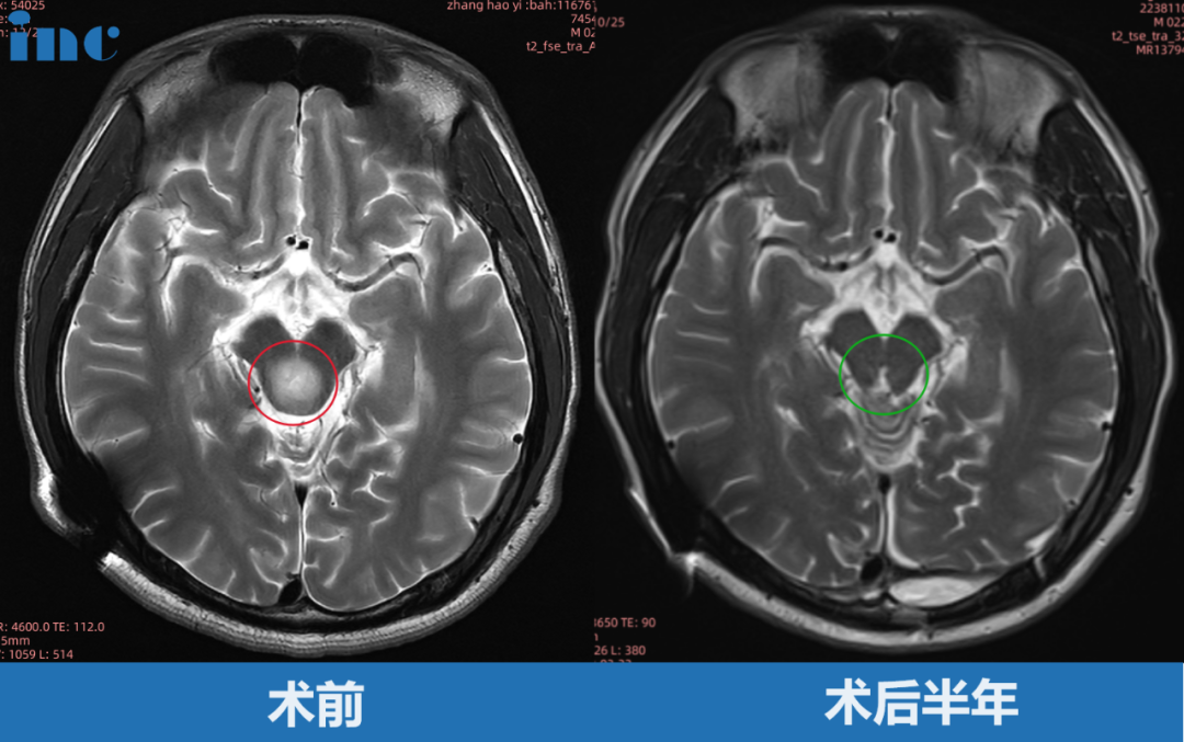 術前術后MRI對比
