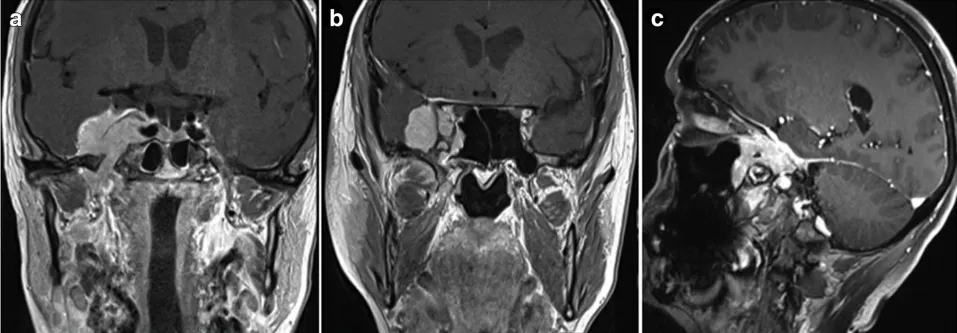 該患者術(shù)前磁共振成像(MRI)圖像。在其右側(cè)海綿竇區(qū)有一病變，且向顳窩、蝶鞍上區(qū)(SOF)、翼腭窩(FR)、眶上裂(FO)、翼腭縫(PPF)、巖斜區(qū)(ITF)及蝶鞍區(qū)(SphS)擴(kuò)展。
