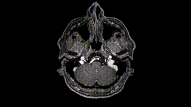 該患者2014年的磁共振成像(MRI)檢查結(jié)果