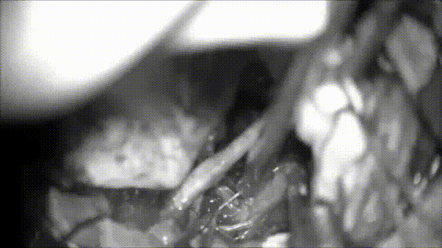 腫瘤的背側(cè)也使用相同的技術(shù)進(jìn)行解剖和移除。如果出現(xiàn)腦干水腫并與腦干緊密貼合，則應(yīng)留下腫瘤殘余物，以避免這些穿支受到任何傷害。