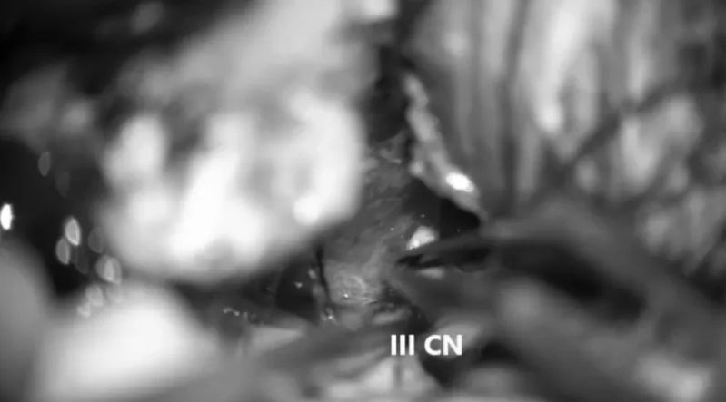逐步地，在腫瘤區(qū)域內(nèi)辨認(rèn)、分離并顯露出動眼神經(jīng)以及位于Dorello管中的外展神經(jīng)，在整個過程中，需特別注重對這些神經(jīng)結(jié)構(gòu)的保護(hù)。