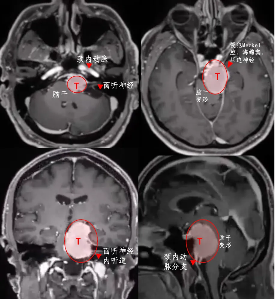 在侵襲前顱窩、中顱窩和后顱窩的情況下，巖斜區(qū)腦膜瘤的手術(shù)難度較大，